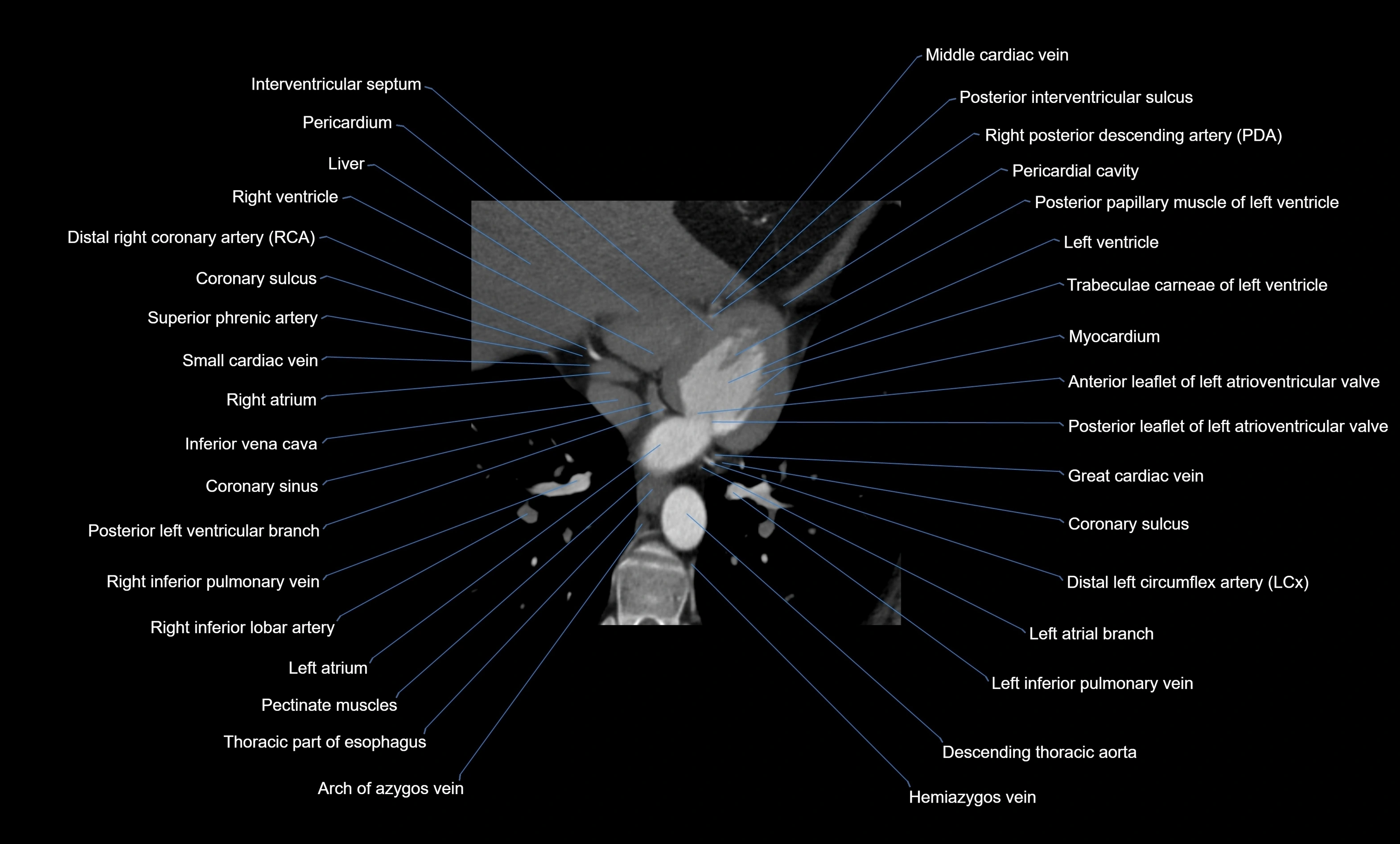 CT heart (coronary angiogram) four chamber view  cross sectional anatomy labelled radiology image -00037.webp